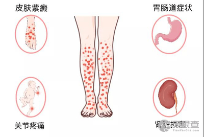 怎么判定得了腎炎（腎炎癥狀的早期表現）